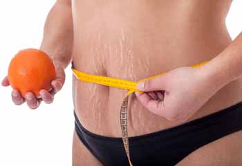 How To Get Rid Of Stretch Marks